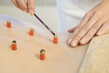 Moxibustion Naturheilpraxis Fünfstern Bad Vilbel